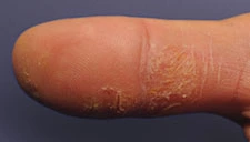 real photo of eczema on thumb