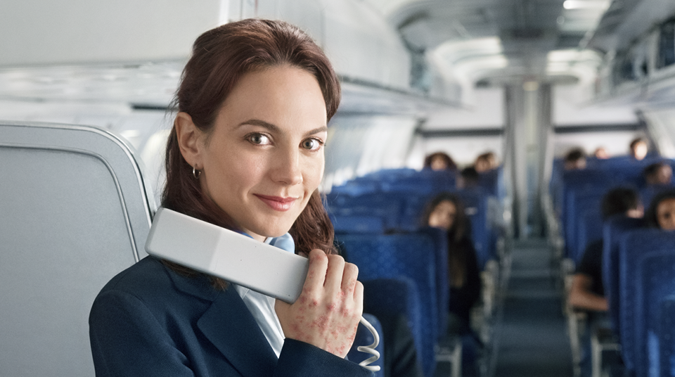 flight attendant with eczema on hand 2
