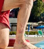 man with eczema on leg