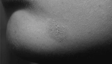 real photo of eczema on chin 1