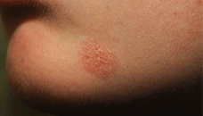 real photo of eczema on chin
