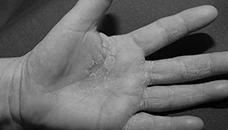 real photo of eczema on left hand 1