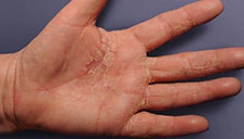 real photo of eczema on left hand