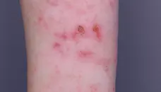 real photo of eczema on forearm
