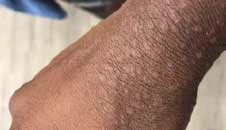 real photo of eczema on wrist