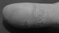 real photo of eczema on thumb 1